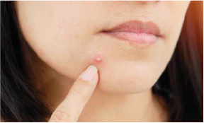 Quick and Easy Ways to Heal Acne... Naturally!